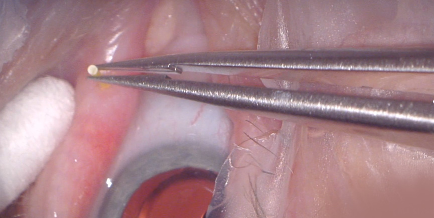 Showing intracanalicular insertion of DEXTENZA
